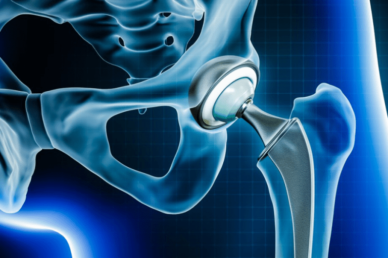 Illustration of artificial hip joint replacement